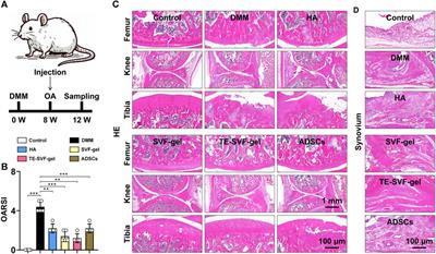 One-step stromal vascular fraction therapy in osteoarthritis with tropoelastin-enhanced autologous stromal vascular fraction gel